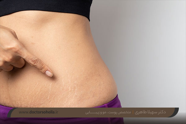 عکس استرچ مارک