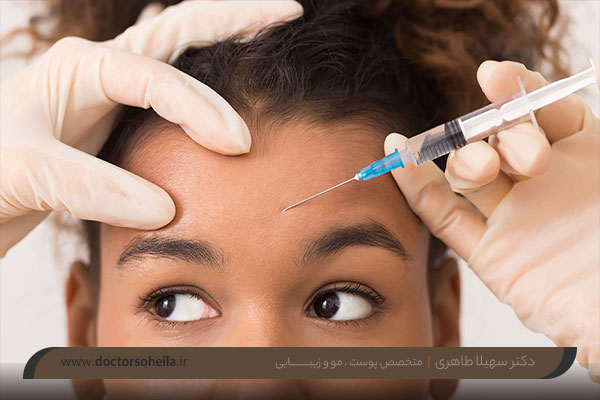 تزریق بوتاکس پیشانی