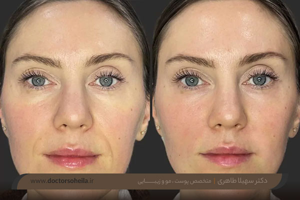فیلر خط خنده