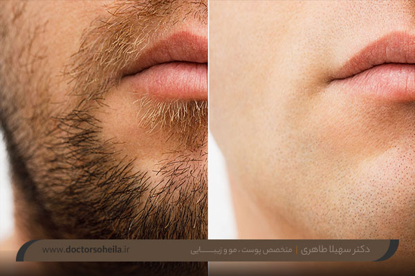 کاشت ریش و سبیل