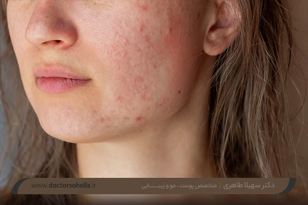 درمان لک صورت