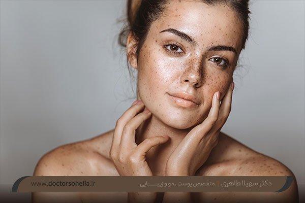 درمان کک و مک