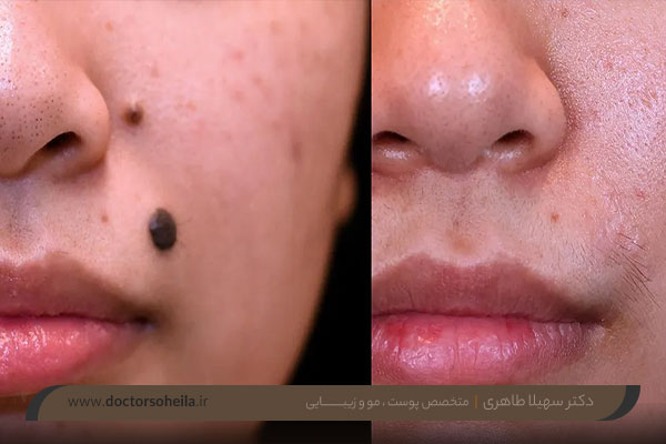 برداشت خال با لیزر co2