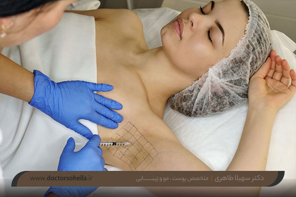 بوتاکس زیر بغل