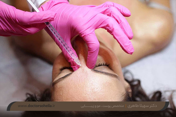 بوتاکس خط اخم