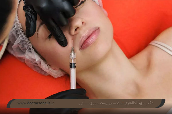 بوتاکس خط خنده