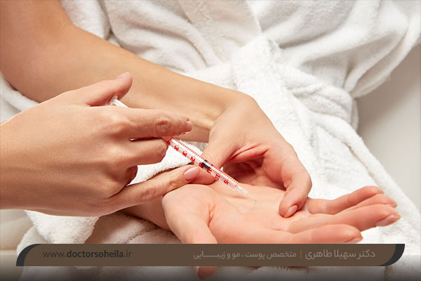 بوتاکس کف دست