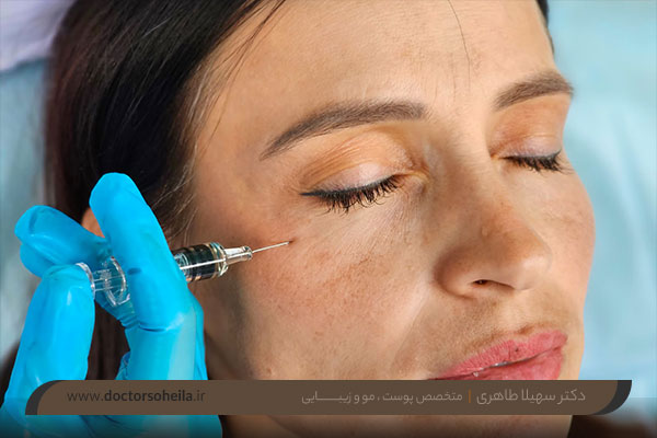 بوتاکس زیر چشم