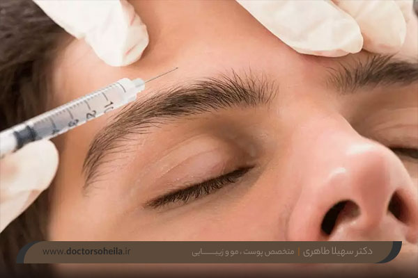 بوتاکس میگرن