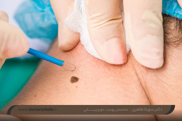 خال بر داری با rf