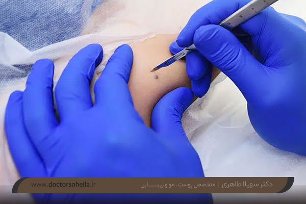 برداشتن خال با جراحی 