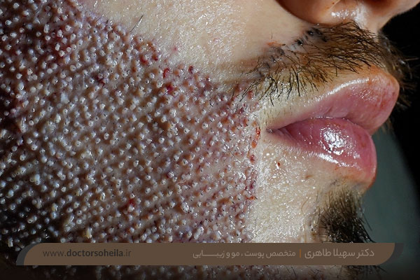 عوارض کاشت ریش و سبیل 