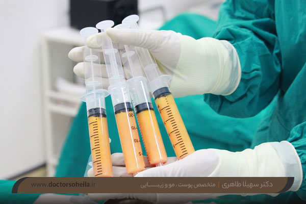 ماندگاری تزریق چربی به صورت