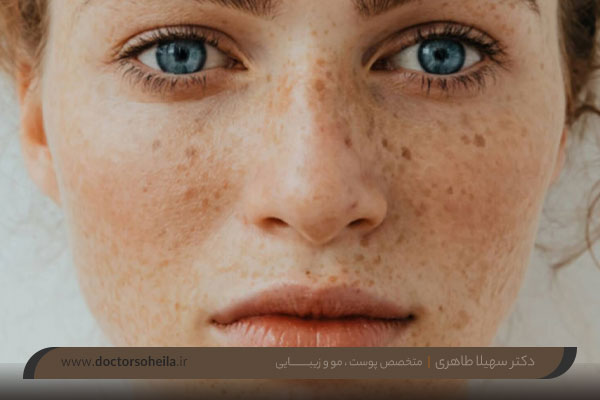 برداشتن کک و مک با پلاسما جت 