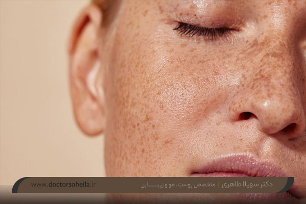 لیزر کک و مک 