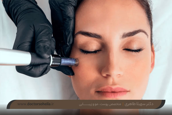 مراقبت های بعد از میکرونیدلینگ 