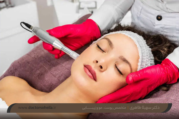 مراقبت بعد از میکرویندلینگ