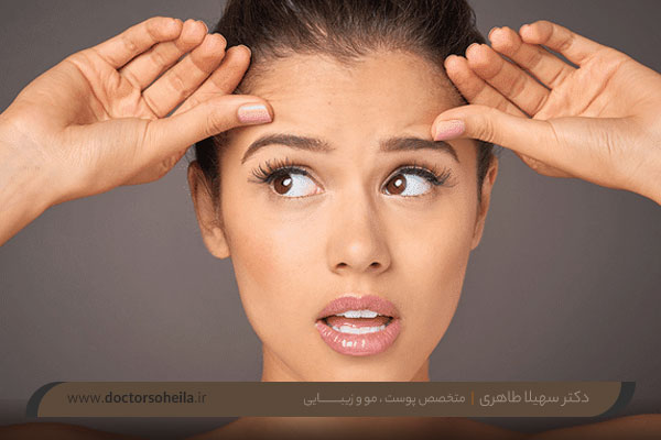 بوتاکس ابرو 