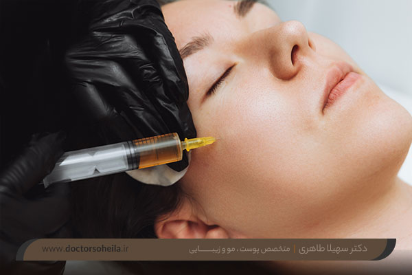 عوارض پی آر پی صورت