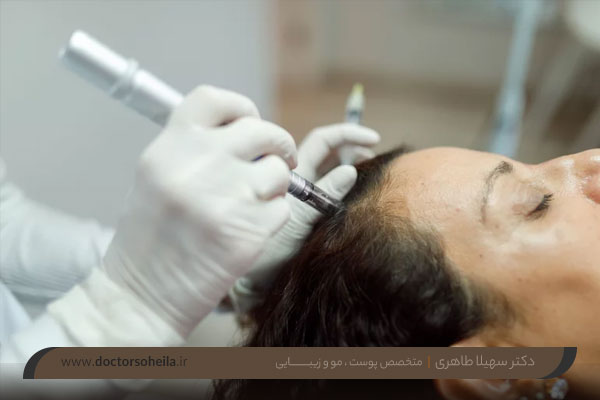 میکرونیدلینگ مو 