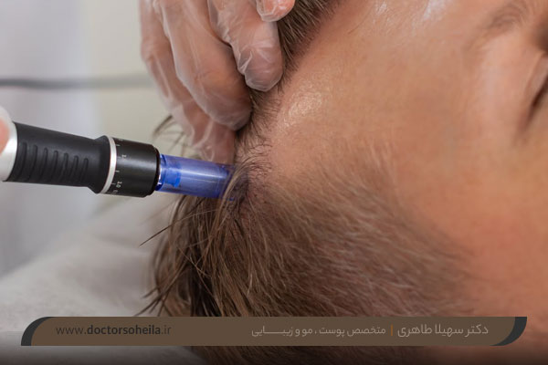 میکرونیدلینگ برای مو