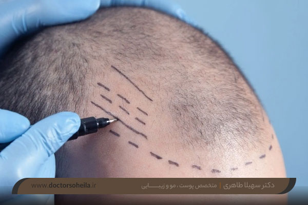 کاشت مو اصفهان 