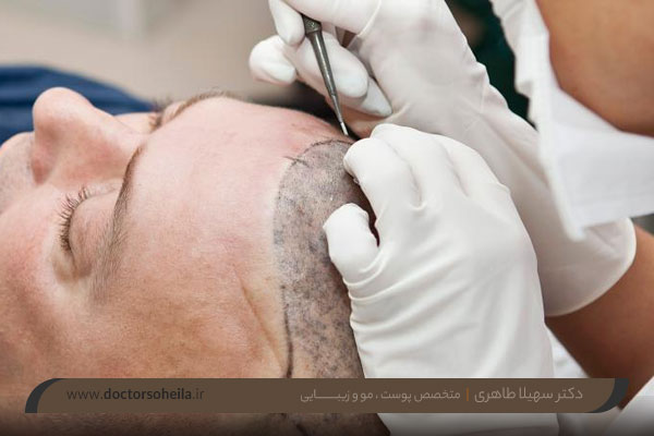 کاشت مو در اصفهان 