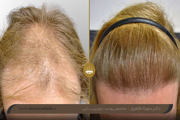 خط رویش کاشت مو طبیعی