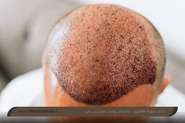 مراقبتهای بعد از عمل کاشت مو