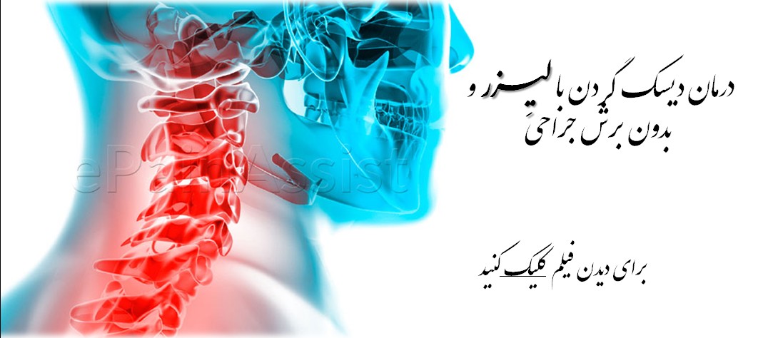  فیلم جراحی لیزری دیسک گردن