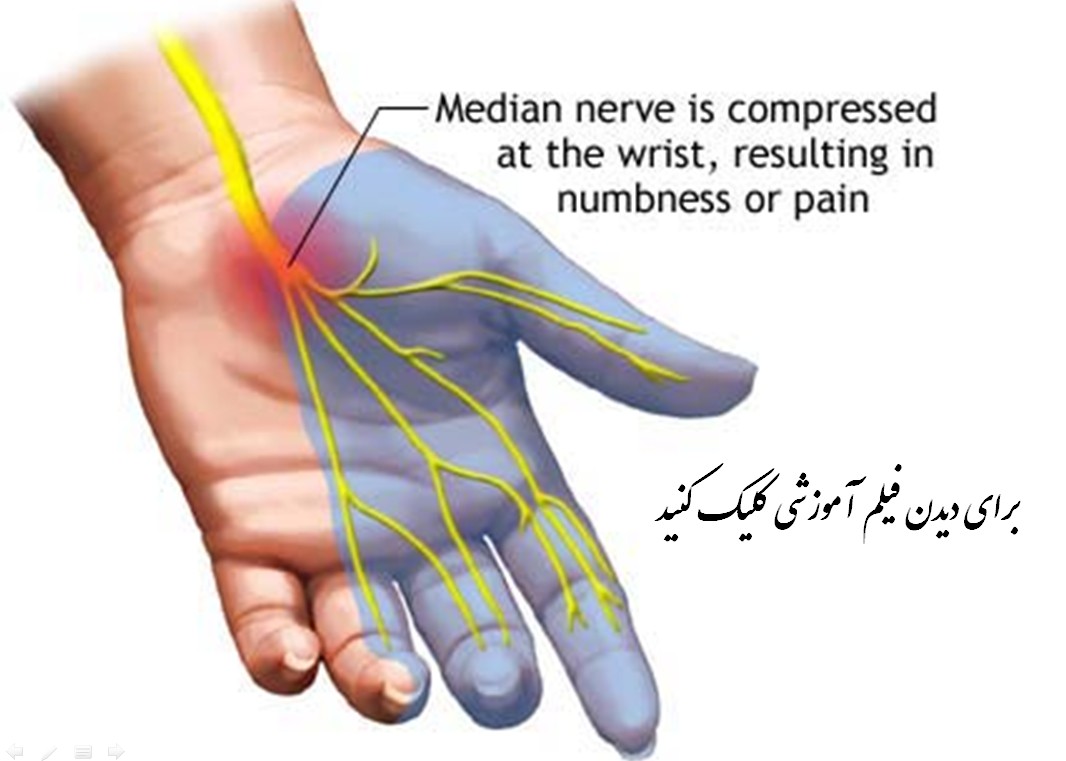 سندرم تونل مچ دست 