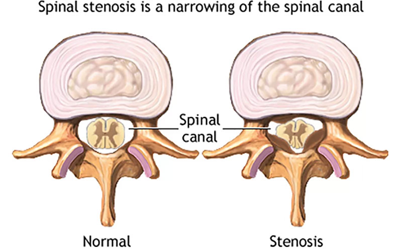 درمان تنگی کانال نخاعی با ورزش