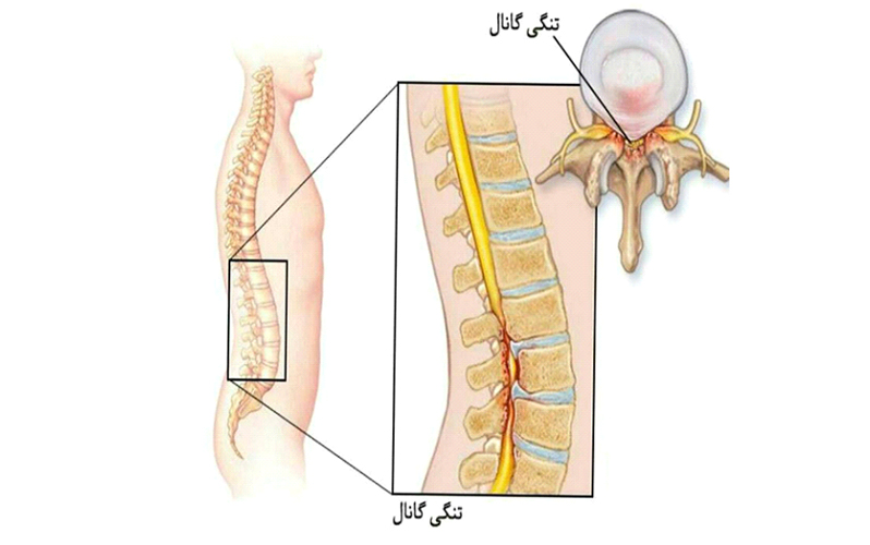 درمان تنگی کانال نخاعی با تمرین