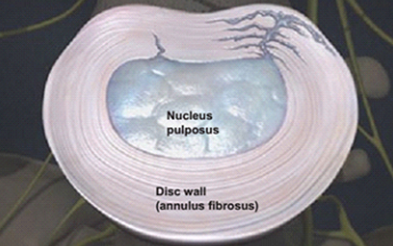 درمان پارگی دیواره دیسک