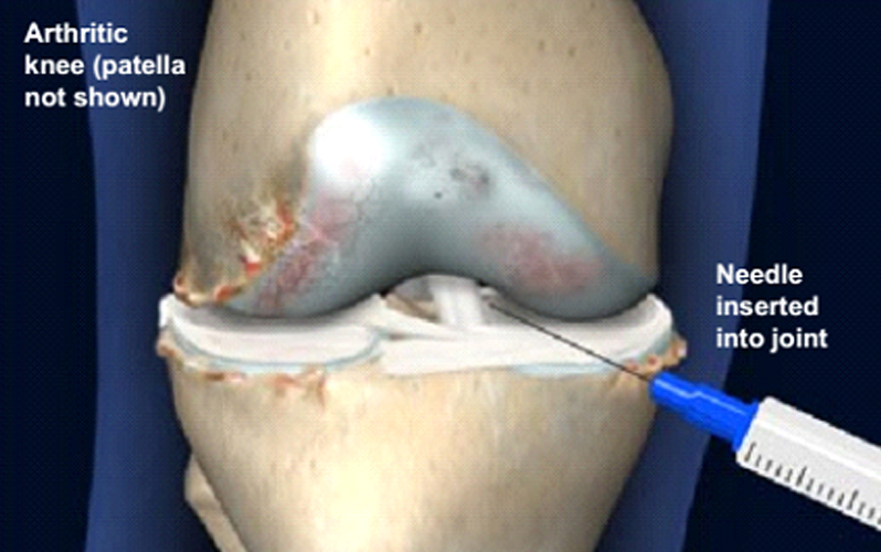 درمان آرتروز زانو با تزریق ژل