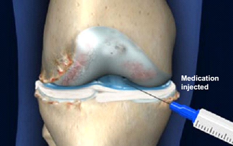 درمان آرتروز زانو