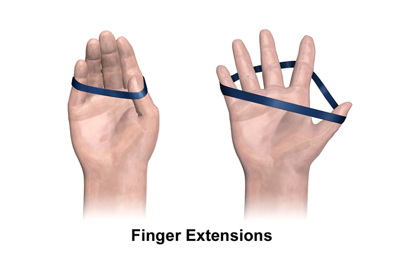 کشیدن انگشت به کمک کش ورزشی برای درمان انگشت ماشه ای