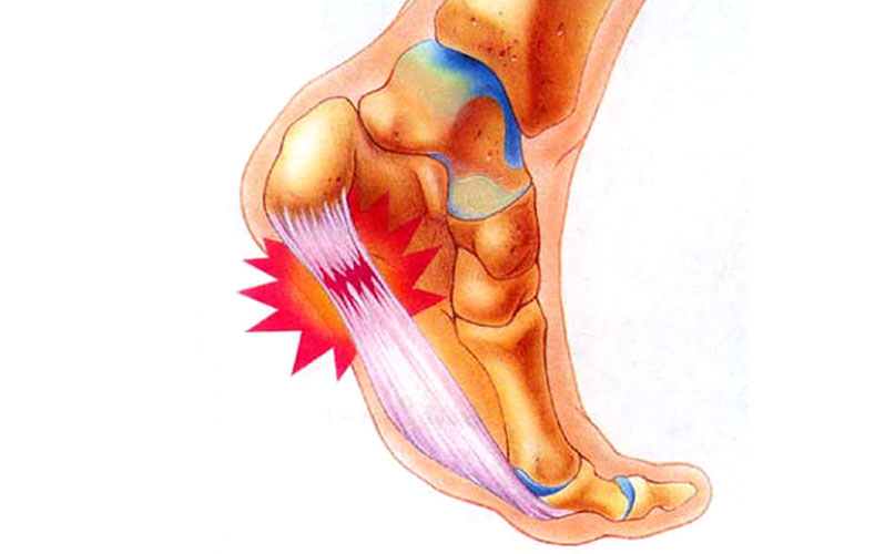 التهاب پلانتار فاسیا