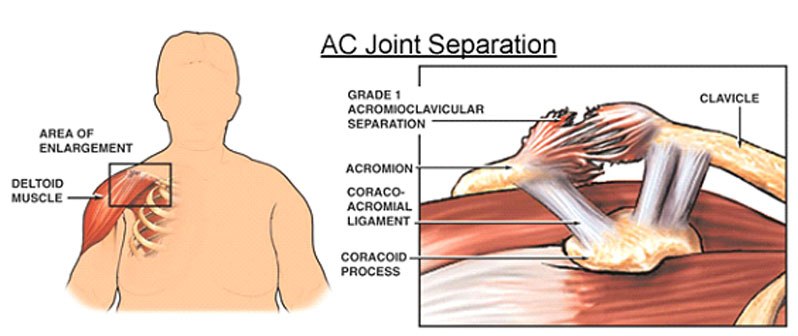 مفصل اکرومیوکلاویکول