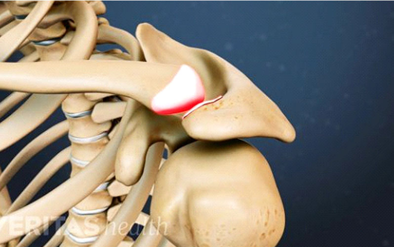 درمان درد مفصل شانه