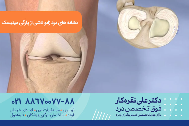 علائم و درمان پارگی مینیسک زانو