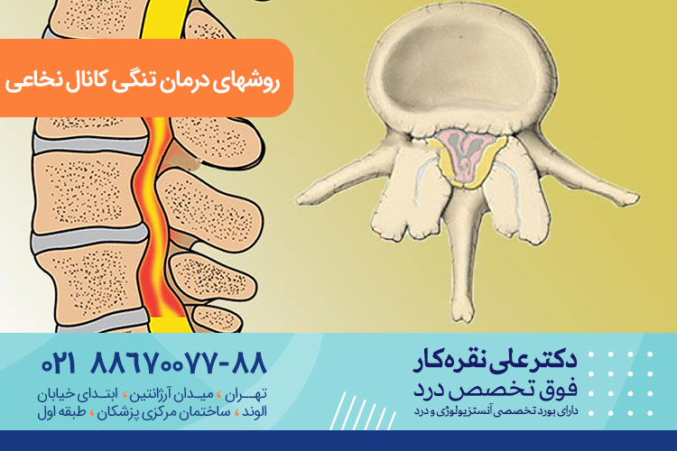 روشهای درمان تنگی کانال نخاعی