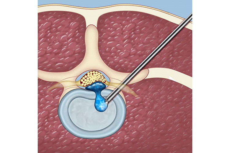 جراحی آندوسکوپی برای درمان بیرون زدگی دیسک