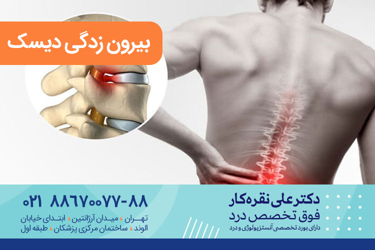 بیرون ‌زدگی دیسک یا فتق دیسک | پیشگیری و عوارض بیرون زدگی دیسک