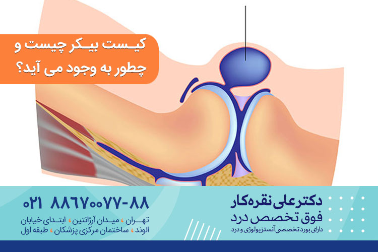 کیست بیکر چیست و چطور به وجود می آید؟	