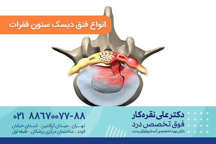  فتق دیسک ستون فقرات