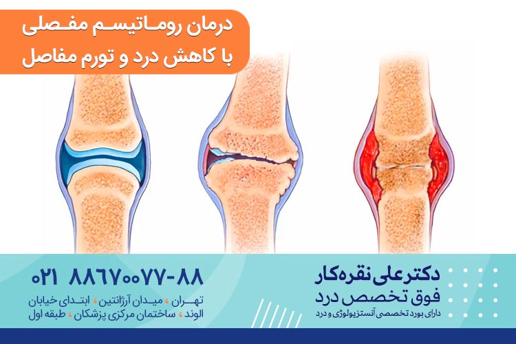 درمان روماتیسم مفصلی با کاهش درد و تورم مفاصل