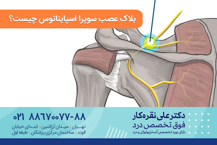 بلاک عصب سوپرا اسپایناتوس