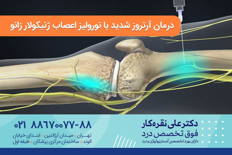 درمان آرتروز شدید با نورولیز اعصاب ژنیکولار زانو