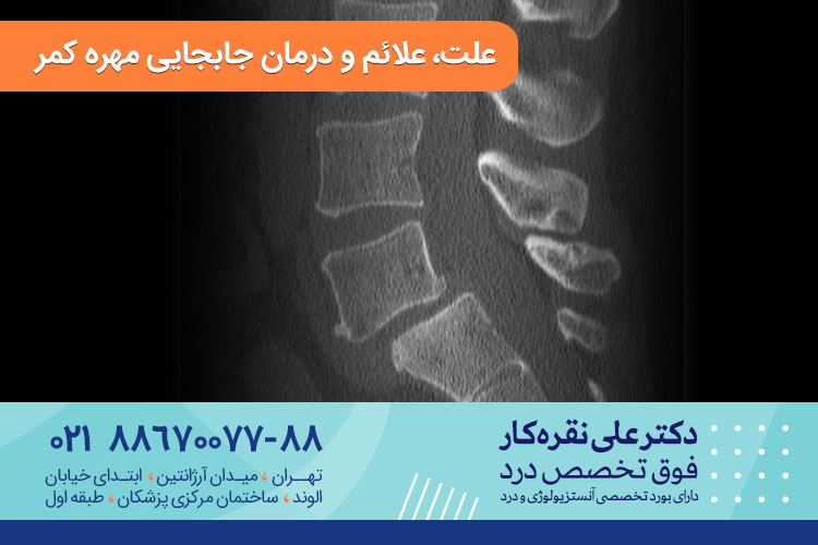 درمان جابجایی مهره کمر